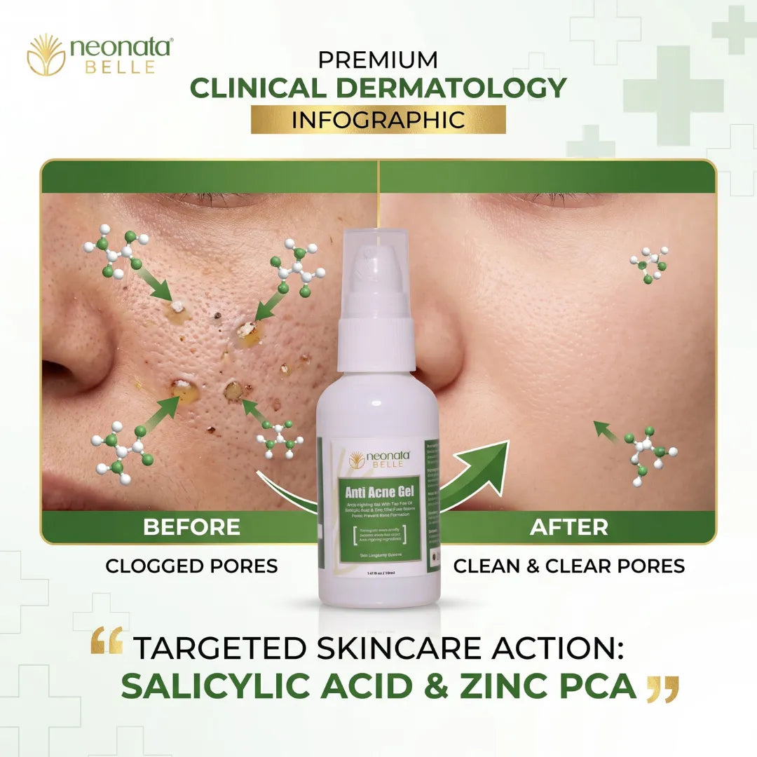 Neonata Belle Anti Acne Gel