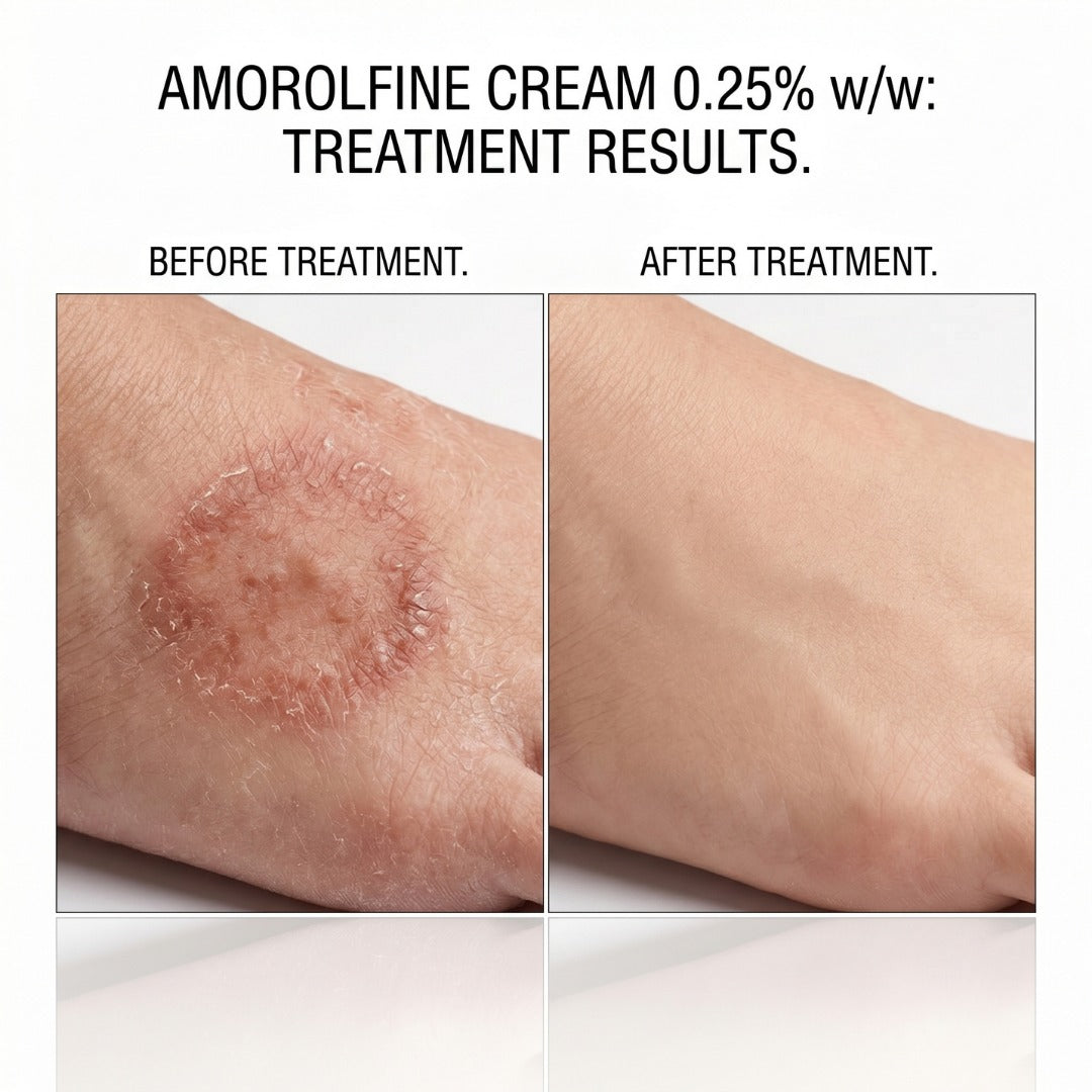 Atfine Cream