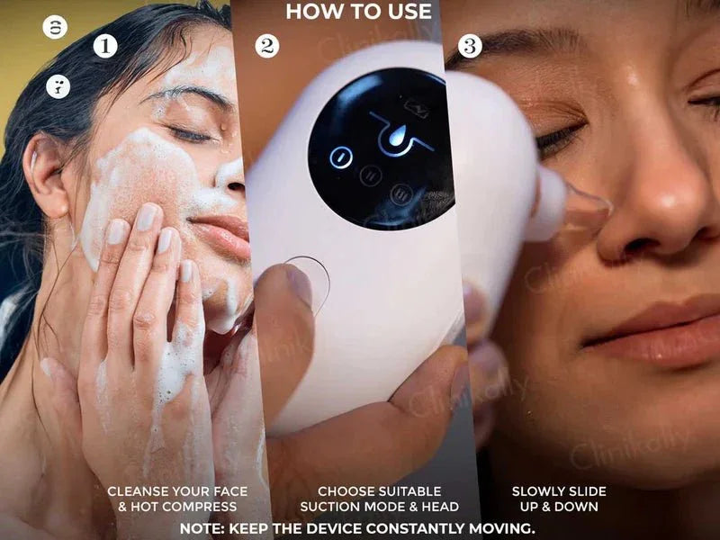 Winston Blackhead Remover - Atomic Pharmacy