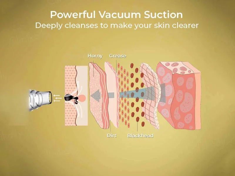 Winston Blackhead Remover - Atomic Pharmacy