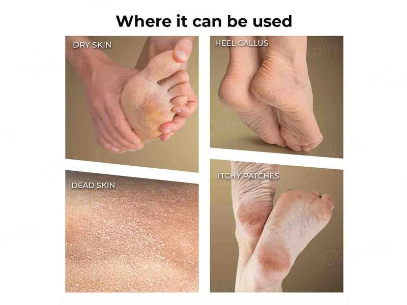 Winston Callus Remover - Atomic Pharmacy